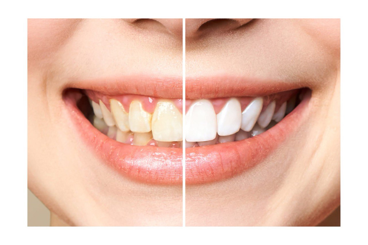 Antes y después tratamiento dental – Clínica Hitachi L'Hospitalet